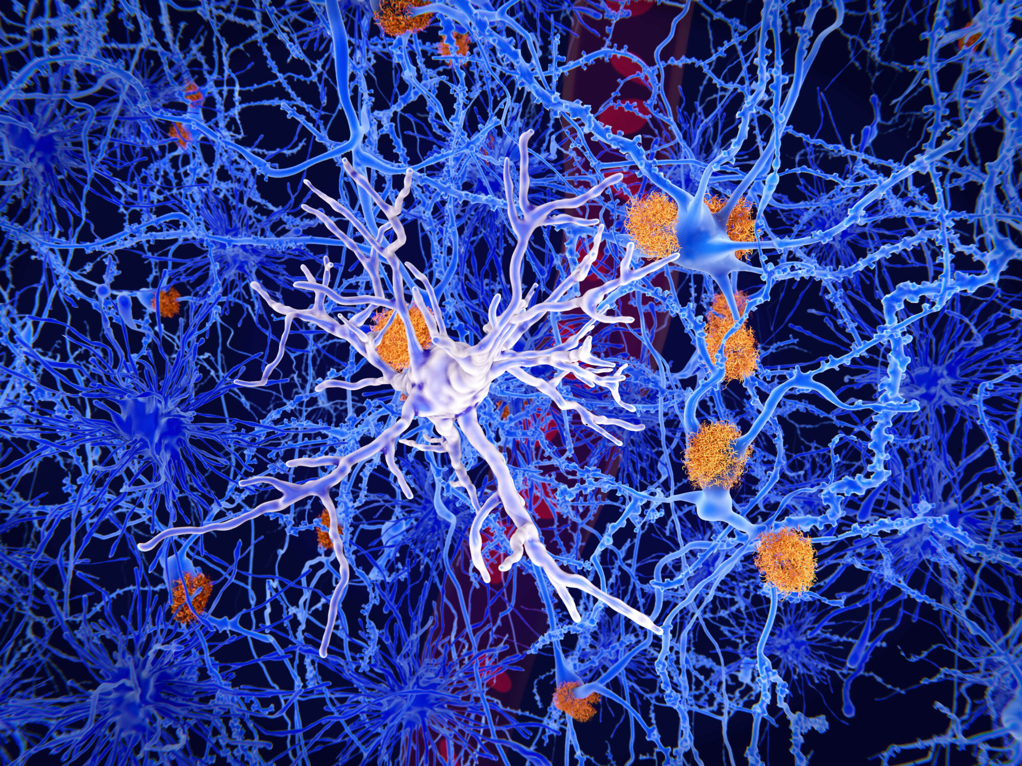 neuroinflammation